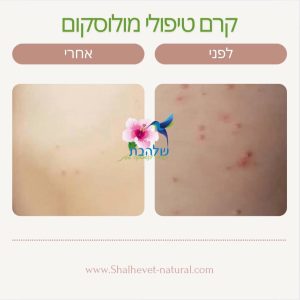 שמן טיפולי ליבלות ויראליות - מולוסקום טיפול טבעי