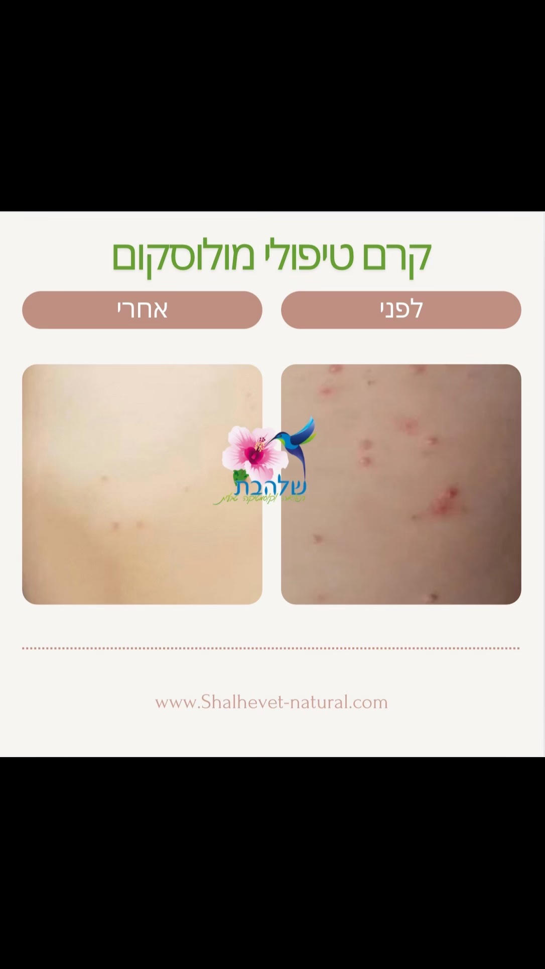 שמן טיפולי ליבלות ויראליות - מולוסקום טיפול טבעי