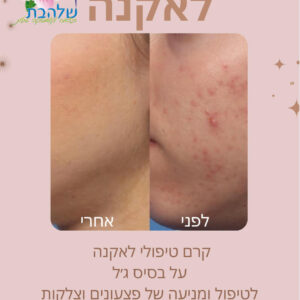 קרם פנים לאקנה (קרם טיפולי)
