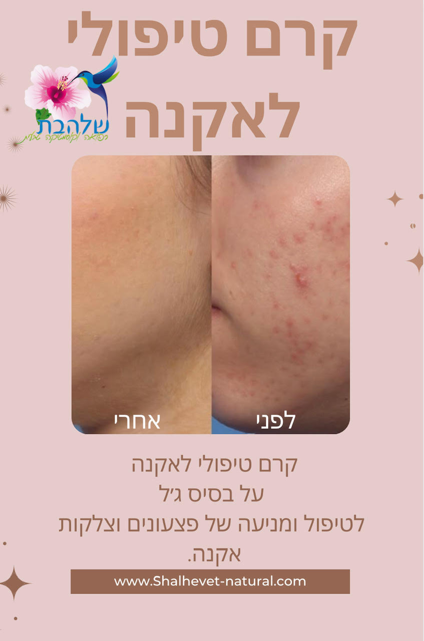 קרם פנים לאקנה (קרם טיפולי)