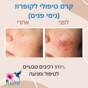 קרם לטיפול בקופרוז - נימים
