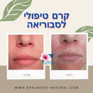 קרם טיפולי לסבוריאה